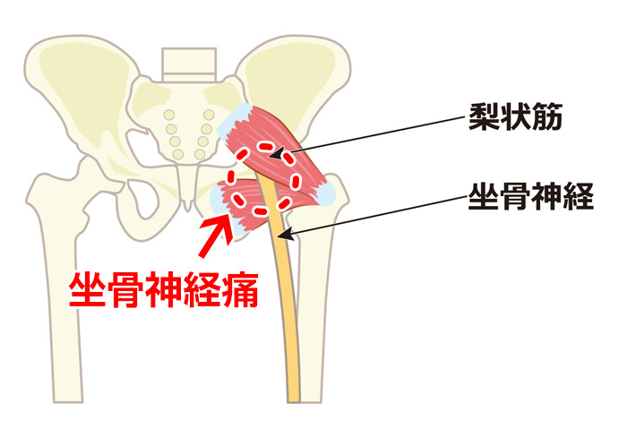 坐骨神経痛の原因箇所の図解