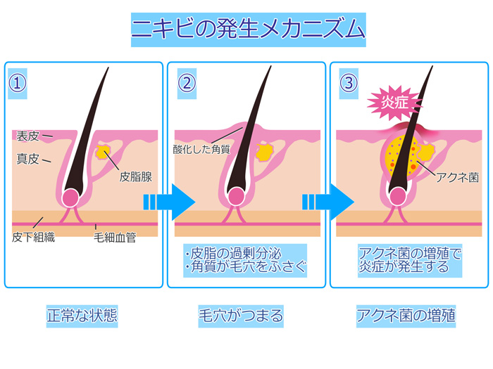 ニキビ発生のメカニズム図解