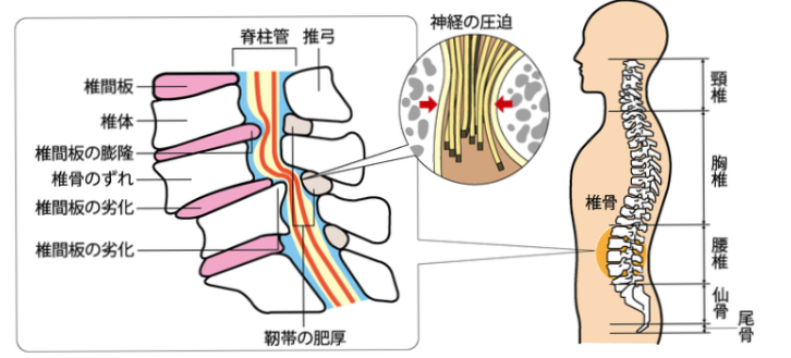 脊柱管イラスト