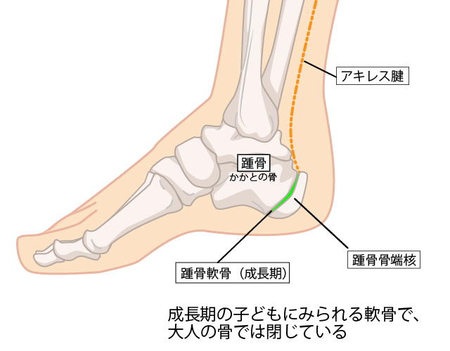 セーバー病図解