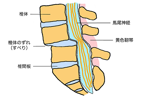 腰椎すべり症イラスト