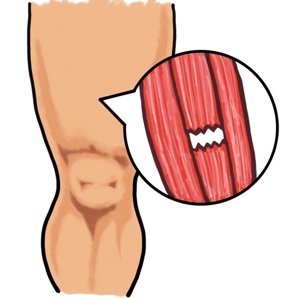 肉離れイメージイラスト