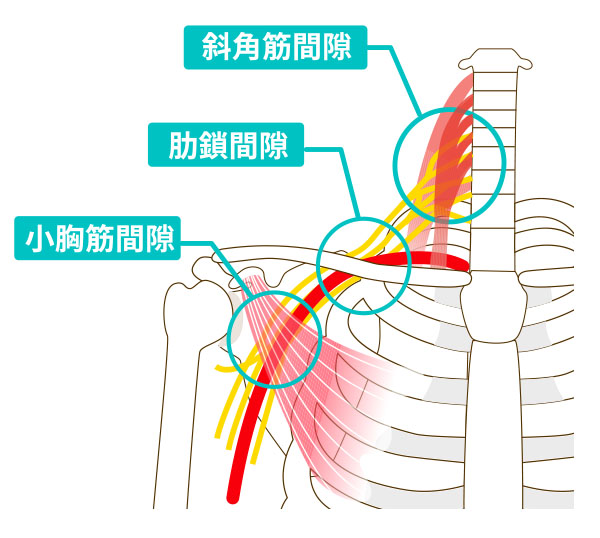 胸郭出口症候群