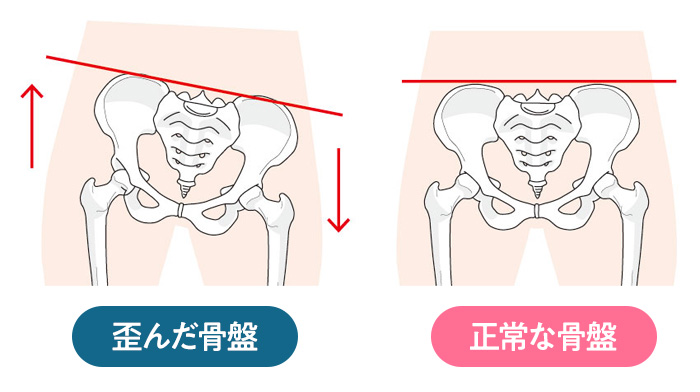 歪んだ骨盤・正常な骨盤イメージイラスト